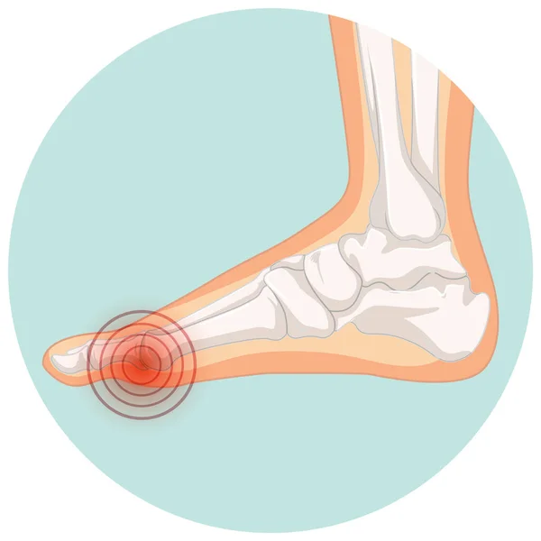 Hallux Valgus Typer Cirkel Mall Illustration — Stock vektor