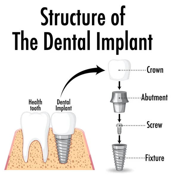 Estructura Del Implante Dental Sobre Fondo Blanco Ilustración — Archivo Imágenes Vectoriales