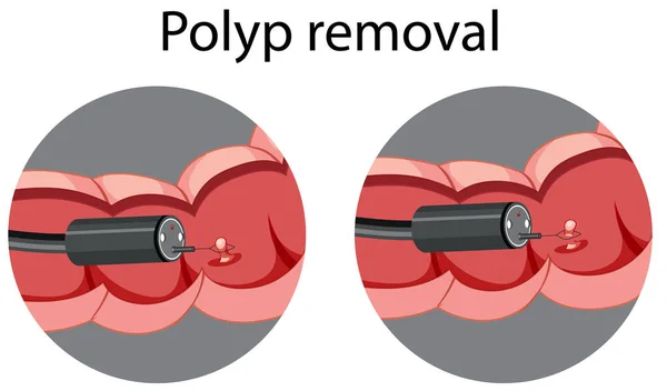 Diagram Som Visar Polyp Borttagning Illustration — Stock vektor