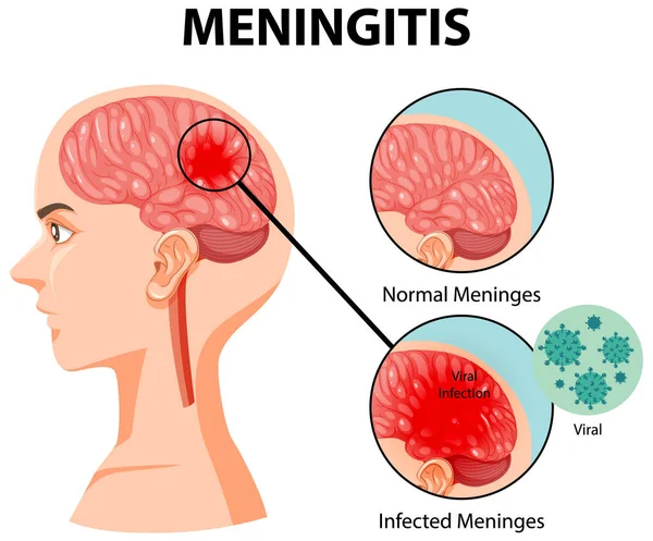 Diagram Znázorňující Meningitidu Ilustraci Lidského Mozku — Stockový vektor