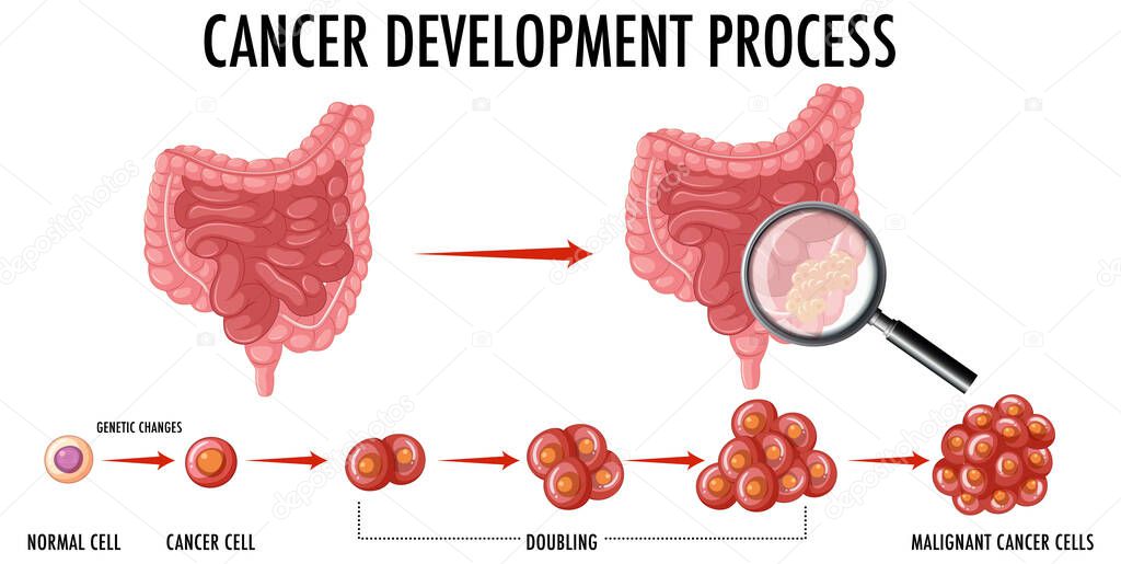 Diagram showing cancer development process illustration