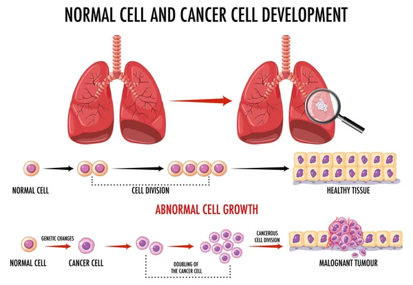 Диаграмма Иллюстрацией Нормальных Раковых Клеток — стоковый вектор