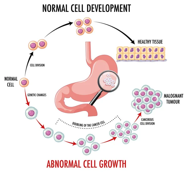 Diagrama Mostrando Normal Células Cancerosas Ilustração — Vetor de Stock