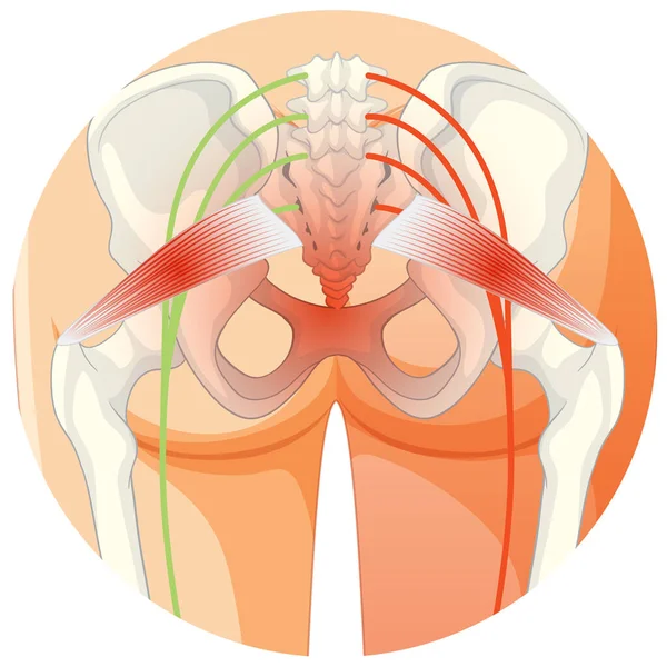 Lower Back Suffering Ankylosing Spondylitis Illustration — Stock Vector