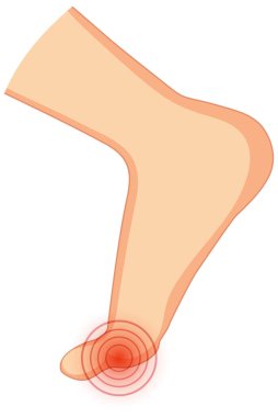 Beyaz arkaplan illüstrasyonunda Hallux valgus tipleri