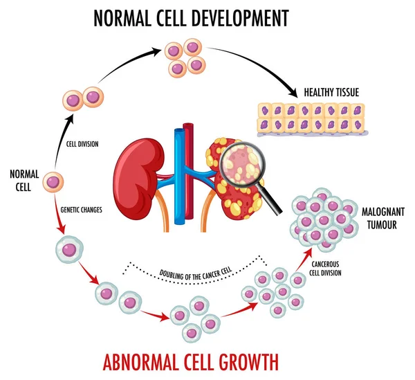 Grafik Zur Illustration Von Normal Und Krebszellen — Stockvektor