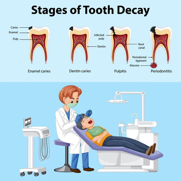 Plakatowe Etapy Próchnicy Zębów Dentystą Badającym Ilustrację Zębów Pacjenta — Wektor stockowy
