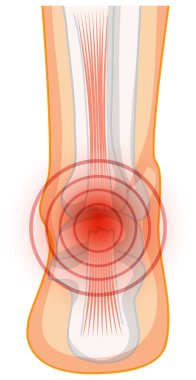Beyaz arkaplan illüstrasyonunda aşil tendo yırtılması