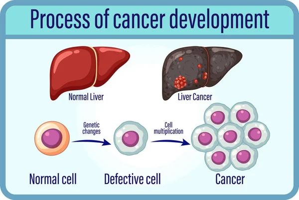 Ilustrasi Pengembangan Kanker Proses - Stok Vektor