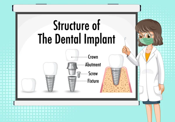 Інфографіка Людини Структурі Імплантації Зубів — стоковий вектор