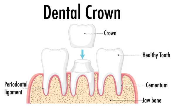Infografía Del Ser Humano Ilustración Corona Dental — Vector de stock