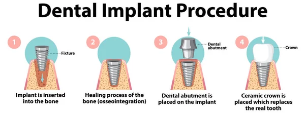 Infographic Του Ανθρώπου Στην Απεικόνιση Της Διαδικασίας Εμφύτευσης Δοντιών — Διανυσματικό Αρχείο