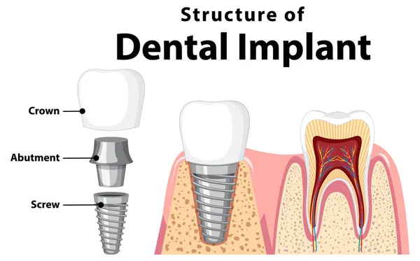 Emberi Fogászati Implantátum Illusztráció Infografikája — Stock Vector