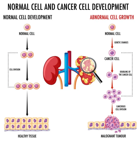 显示正常细胞和癌细胞的示意图 — 图库矢量图片