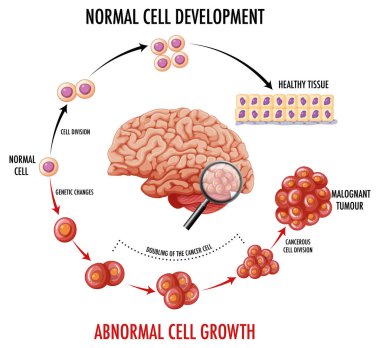 İnsan beyni ve kanser örneklerini gösteren diyagram
