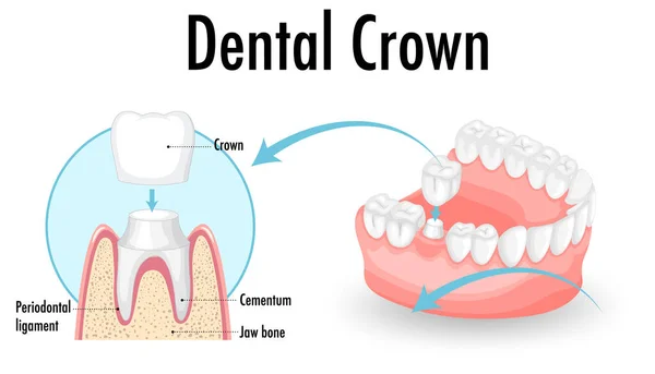 Infografía Del Ser Humano Ilustración Corona Dental — Archivo Imágenes Vectoriales