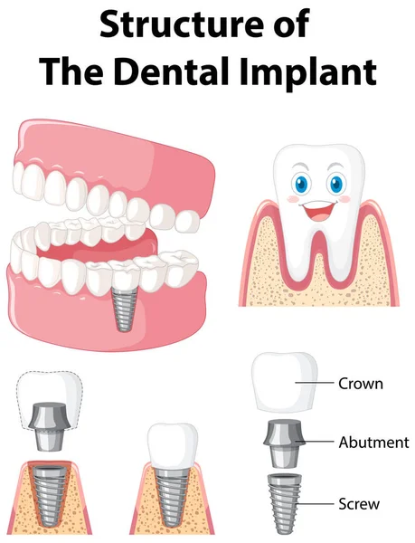 Infographic of human in structure of the dental implant illustration