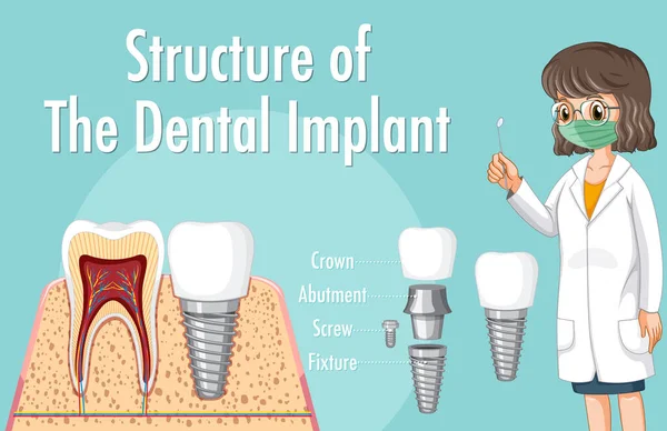 Infografía Del Humano Estructura Ilustración Del Implante Dental — Archivo Imágenes Vectoriales