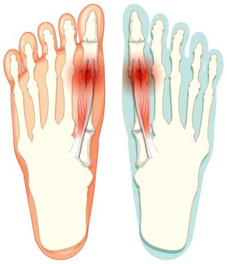 Beyaz arkaplan illüstrasyonunda Hallux valgus tipleri