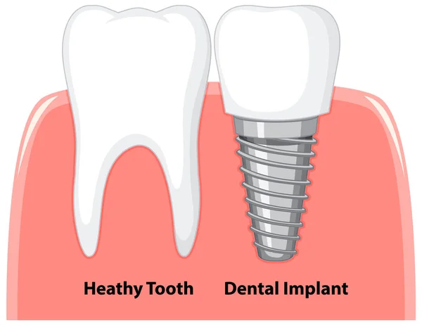 Dente Alto Implante Dentário Goma Sobre Fundo Branco Ilustração —  Vetores de Stock