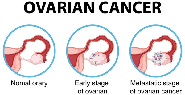 Diagram Showing Ovarina Cancer Human Illustration — Vector de stock