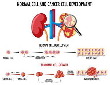 Normal ve kanser hücresi çizimleri gösteren diyagram