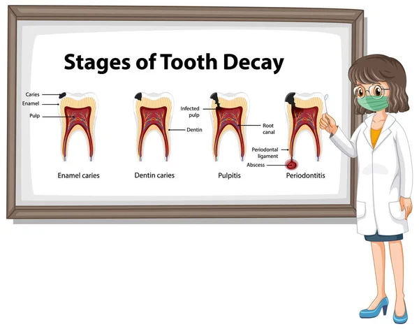 Infographic of human in the stages of tooth decay illustration