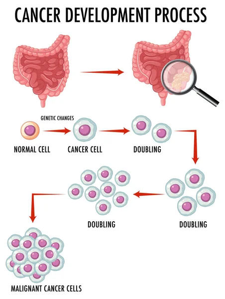 Diagram Menunjukkan Sel Normal Dan Kanker Dalam Ilustrasi Manusia - Stok Vektor