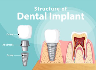 Diş implantı illüstrasyonunda insan yapısı hakkında bilgi