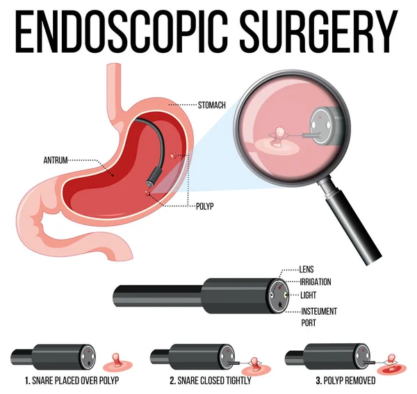 Illustrazione Della Chirurgia Endoscopica — Vettoriale Stock