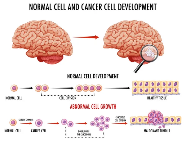 示出人类正常细胞和癌细胞的示意图 — 图库矢量图片