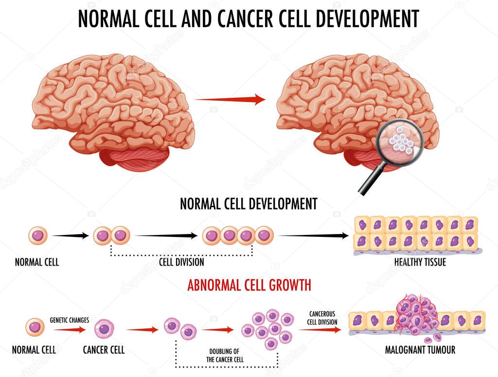 Diagram showing normal and cancer cells in human illustration