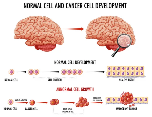 正常細胞とがん細胞のイラスト図 — ストックベクタ