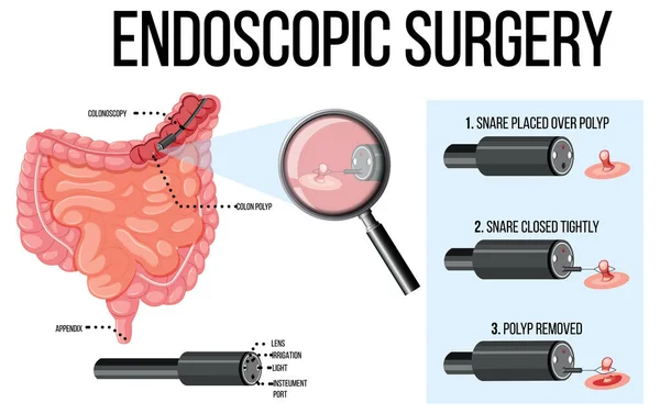 Diagrama Que Muestra Ilustración Cirugía Endoscópica — Vector de stock