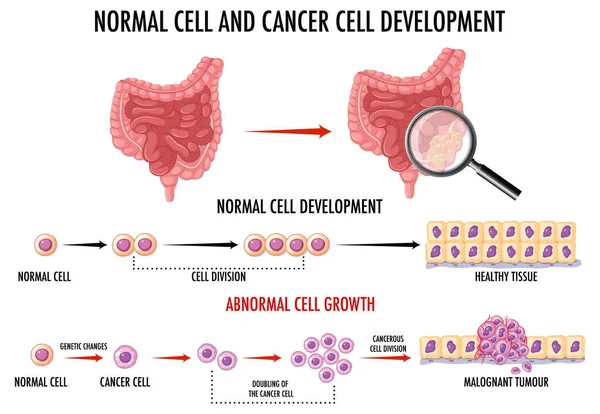 显示正常细胞和癌细胞的示意图 — 图库矢量图片