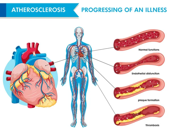 Ateroskleróza Progrese Onemocnění Ilustrace — Stockový vektor