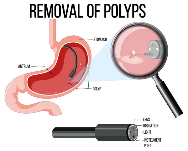 Diagram Zobrazující Odstranění Ilustrace Polypů — Stockový vektor