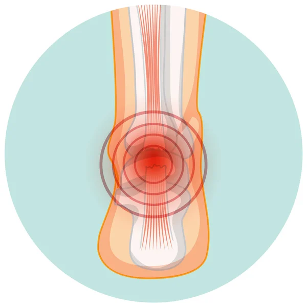 Akilles Senruptur Cirkel Mall Illustration — Stock vektor