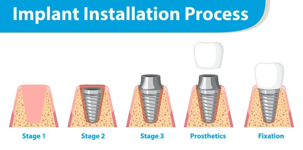 Infografía Del Humano Instalación Implantes Ilustración Del Proceso — Vector de stock