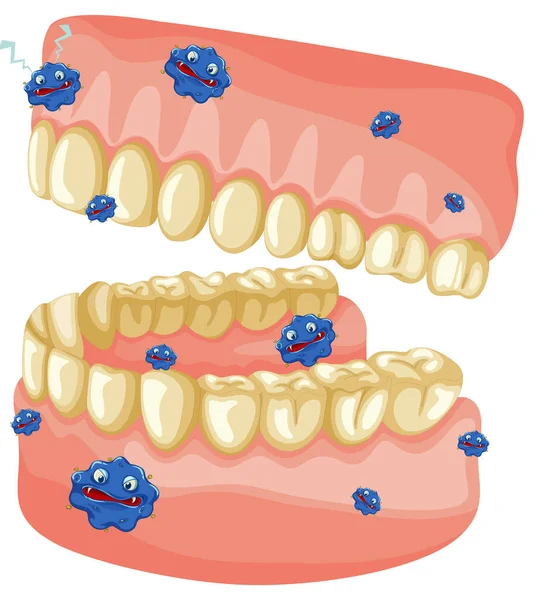 Modelo Dentes Humanos Amarelos Com Ilustração Bactérias —  Vetores de Stock