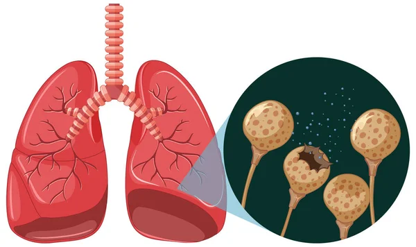 Mold Spores Grow Human Lungs Illustration — Stock vektor