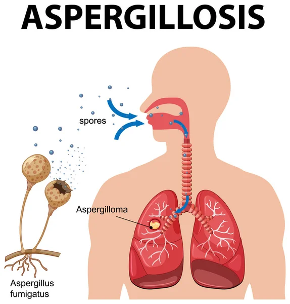 Schemat Pokazujący Zakażenie Aspergillus Ilustracja — Wektor stockowy