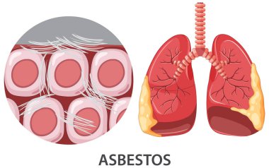 Asbestosis on human lungs illustration