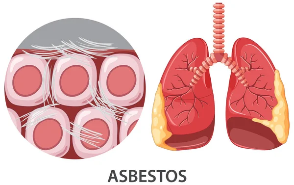 Asbestosis Human Lungs Illustration — Archivo Imágenes Vectoriales