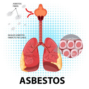 Akciğerlerdeki asbestozu gösteren diyagram