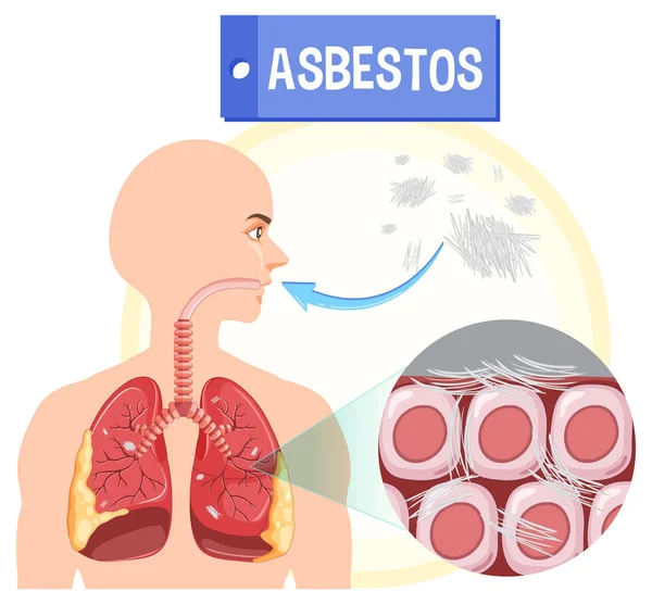 Diagrama Que Muestra Asbestosis Los Pulmones Ilustración — Archivo Imágenes Vectoriales