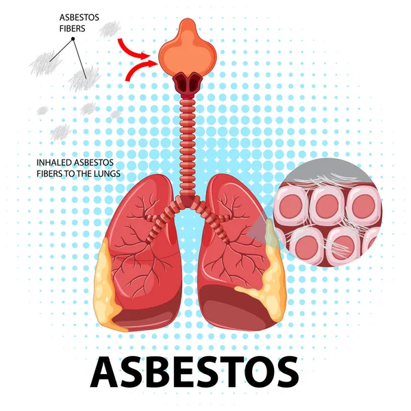 Akciğerlerdeki Asbestozu Gösteren Diyagram — Stok Vektör
