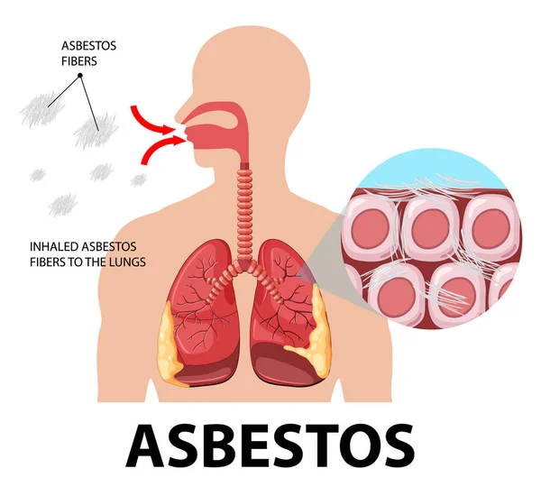 Diagrama Que Muestra Asbestosis Los Pulmones Ilustración — Archivo Imágenes Vectoriales