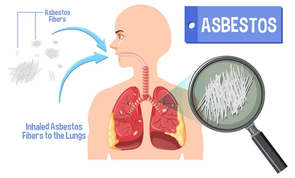 Diagrama Que Muestra Asbestosis Los Pulmones Ilustración — Archivo Imágenes Vectoriales