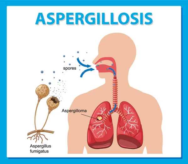 Obrázek Znázorňující Ilustraci Infekce Aspergillus — Stockový vektor